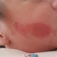 婴儿鲜红斑痣初期图片