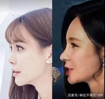 鼻子如何变高变挺