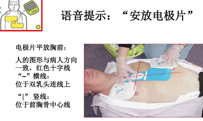 除颤的操作过程