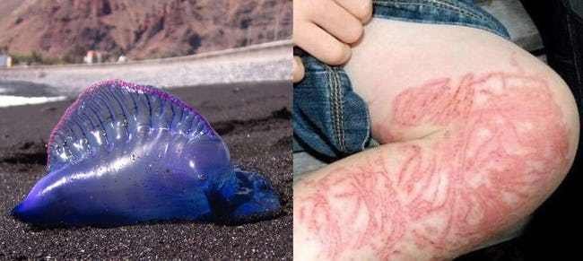 意大利海域遭受水母入侵，被水母刺伤后应该如何处理？