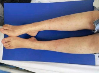 西安一位30岁的女子双腿反复出现网格样青紫，她这是怎么了？