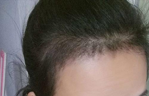 掉头发费钱，植发费用换算后超房价，植发贵是因为技术贵吗？