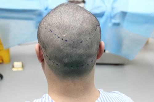 掉头发费钱，植发费用换算后超房价，植发贵是因为技术贵吗？