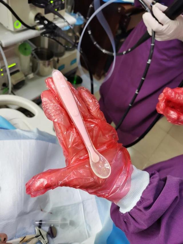 广州一女子误吞17厘米长塑料勺，她为何会这么做？