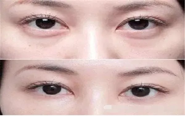 提眉术有哪些注意事项？