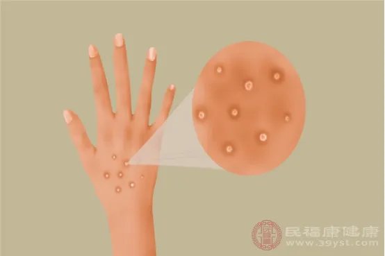 手上长透明小水泡的原因是什么