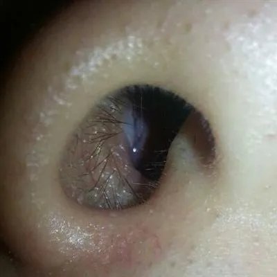 尘螨过敏性鼻炎是怎么回事?