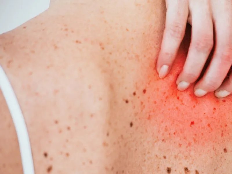 湿疹和皮炎的区别