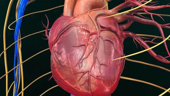 什么情况下做心脏支架