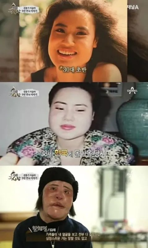 曾是高配版林允儿，整容上瘾后自己注射色拉油，结果怎么样了呢？