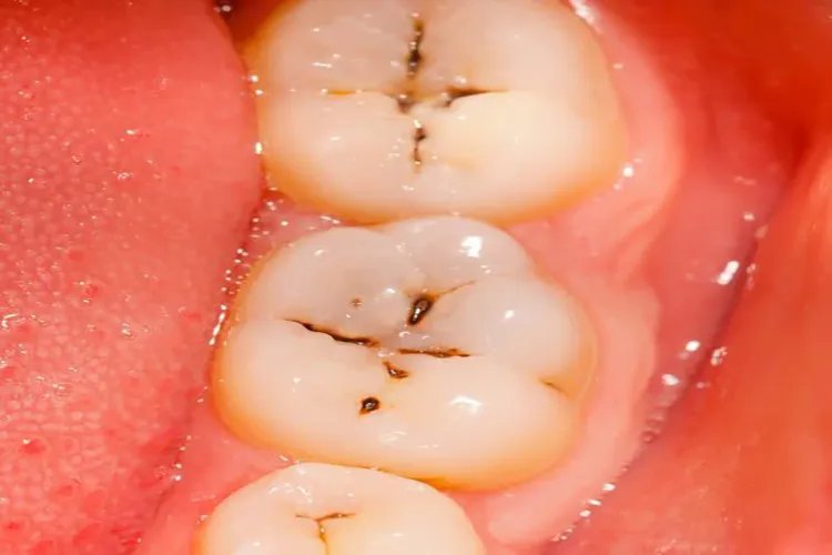 龋病牙齿图片