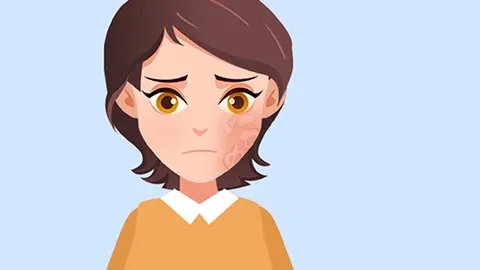 怎样去除眼角细纹