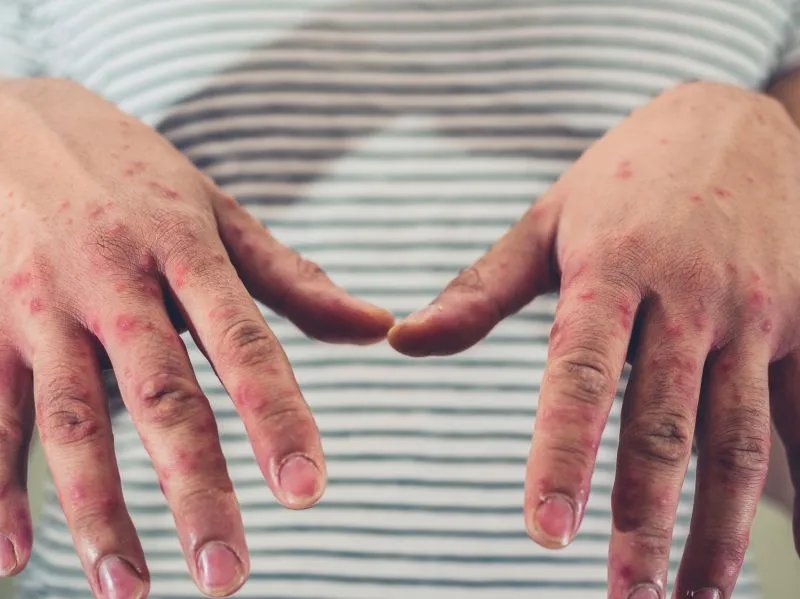 手足口病应该怎么用药