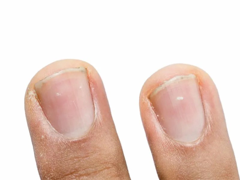 指甲凹陷的原因