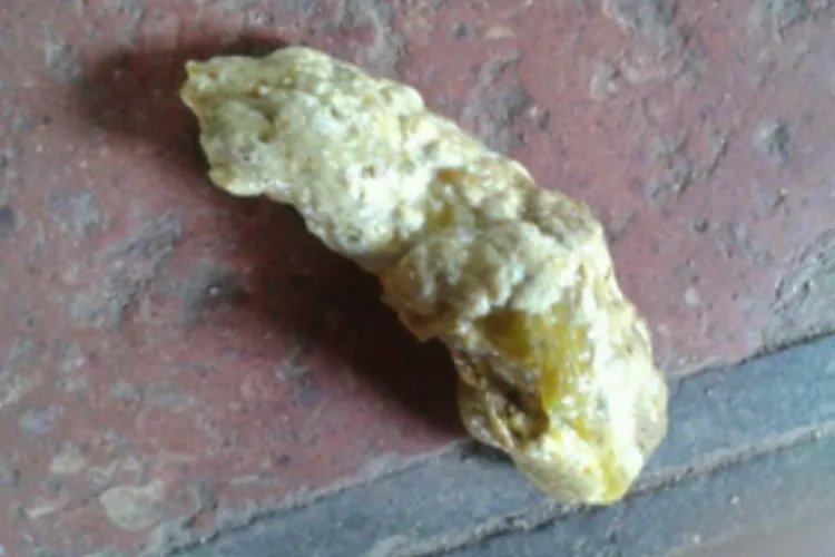 大便颜色9种图解