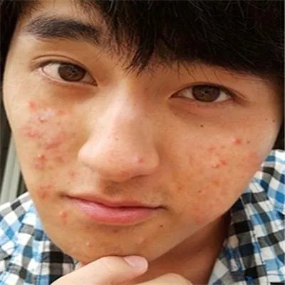 男士祛痘的方法有哪些