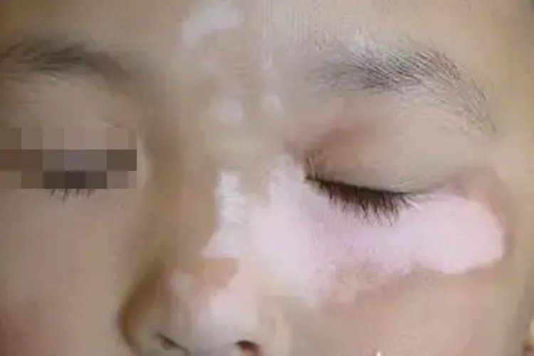 小孩白癜风图片