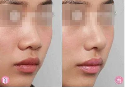 隆鼻尖手术的效果如何