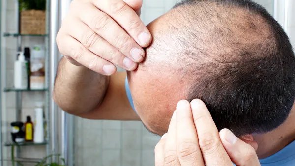 脂溢性脱发的治疗