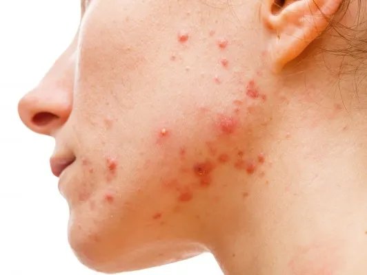 脸上有痤疮怎么办