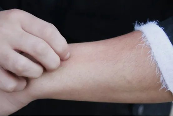 什么是凹陷性疤痕