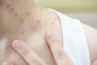 虫咬性皮炎是不是过敏 虫咬性皮炎和过敏区别要知道