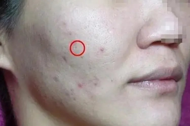 火疖子成熟的图片