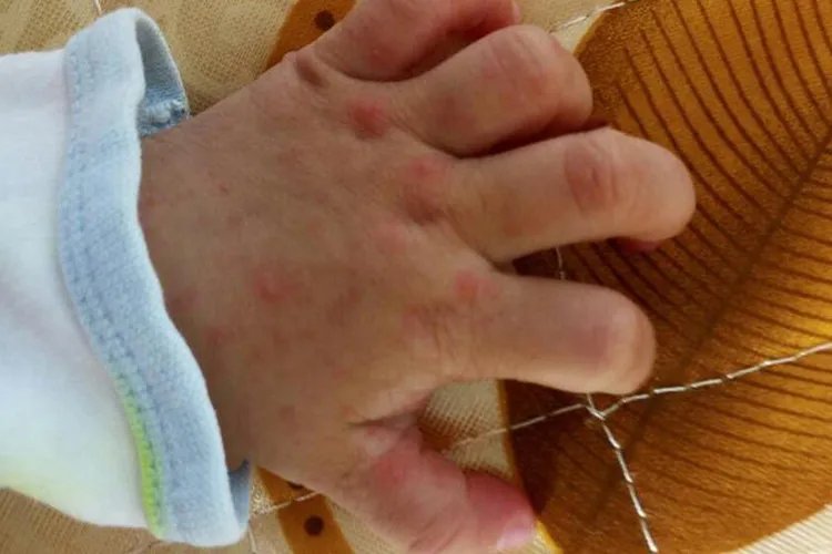 小孩手足口病轻微图片