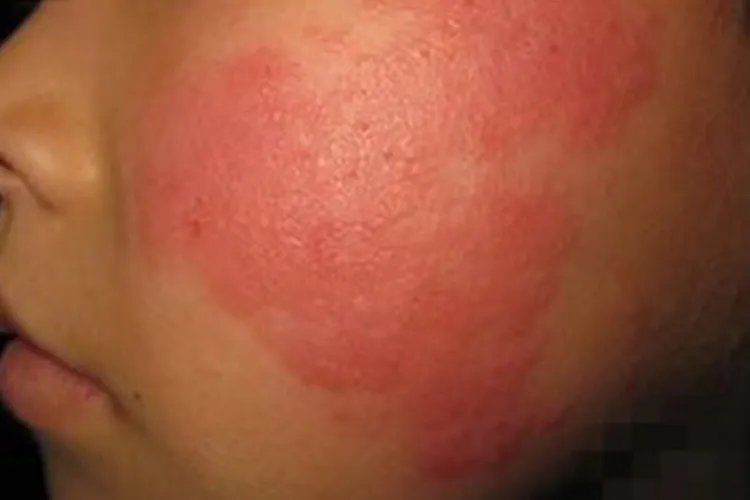 沙尘暴可以诱发什么部位的疾病