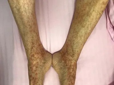 进行性色素性紫癜性皮肤病症状图片