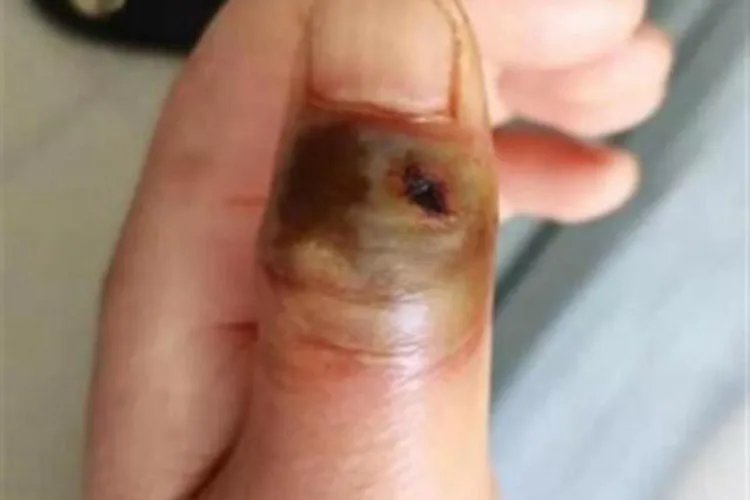 炭疽病皮肤发黑图片