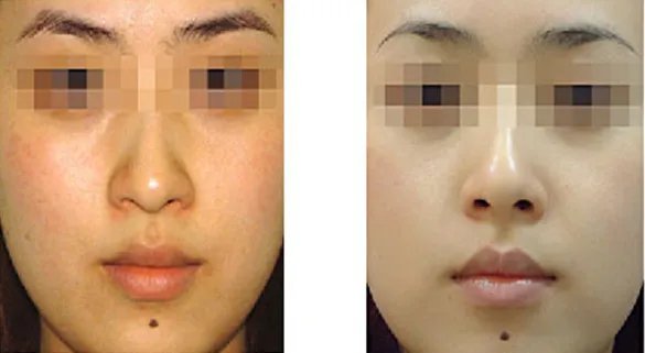 激光嫩肤的价格是多少