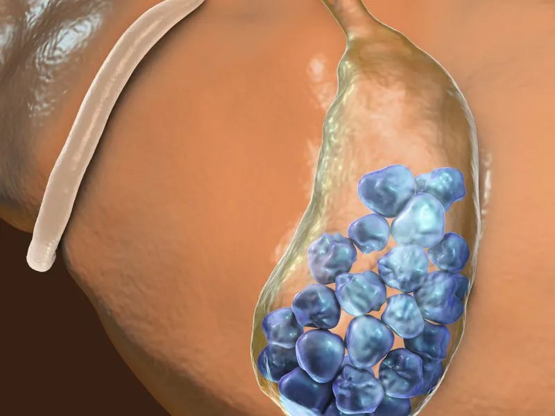 肾结石的饮食疗法