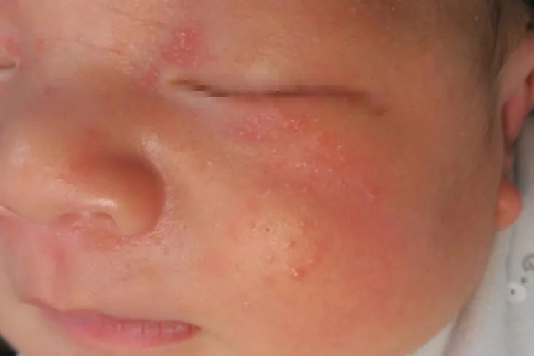六个月宝宝湿疹图片