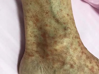 进行性色素性紫癜性皮肤病症状图片