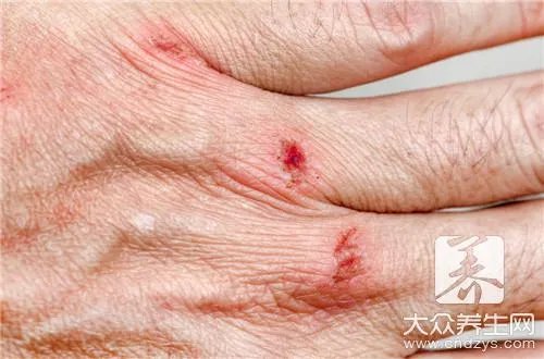 瘢痕增生的治疗方法是什么