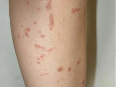 扁平疣样职业性疣赘小腿症状图片