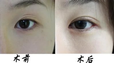 双眼皮修复多少钱