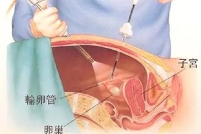 结扎接通手术过程图