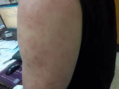 进行性色素性紫癜性皮肤病症状图片