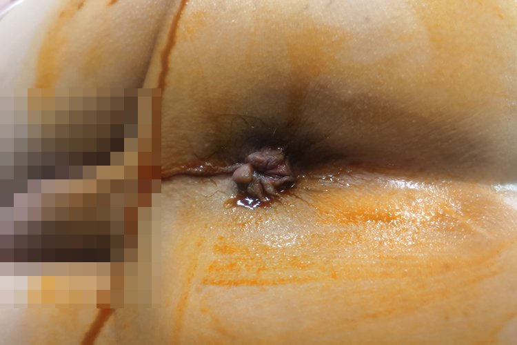 正常屁眼与痔疮图片