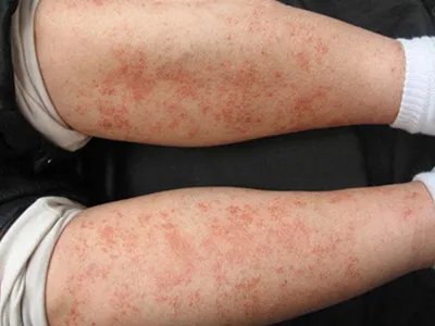 进行性色素性紫癜性皮肤病症状图片