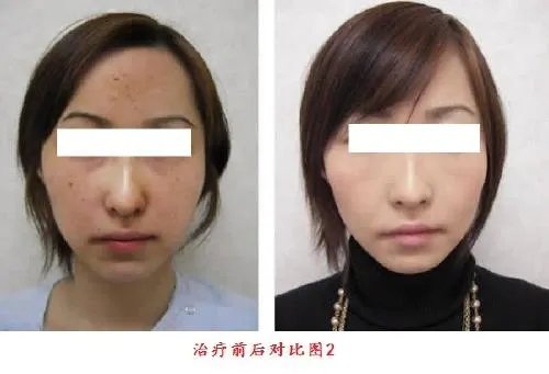 光子嫩肤去红血丝效果好不好