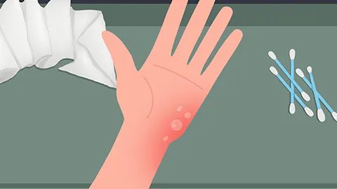 被开水烫伤用什么药