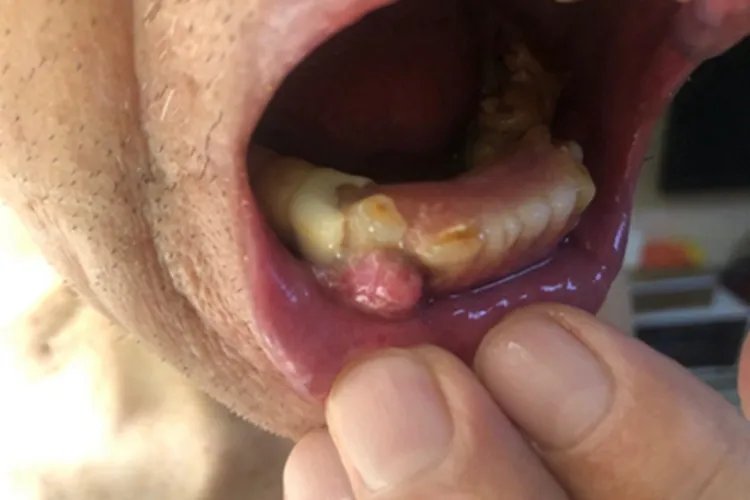 牙龈瘤牙龈肉球图片