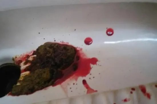 大便颜色9种图解