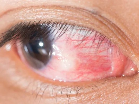 眼部脂肪粒怎么去除