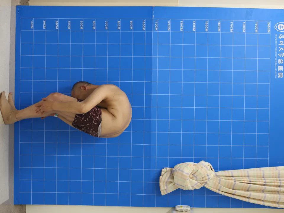 打开折叠人生——极重度脊柱后凸3-ON折叠人手术