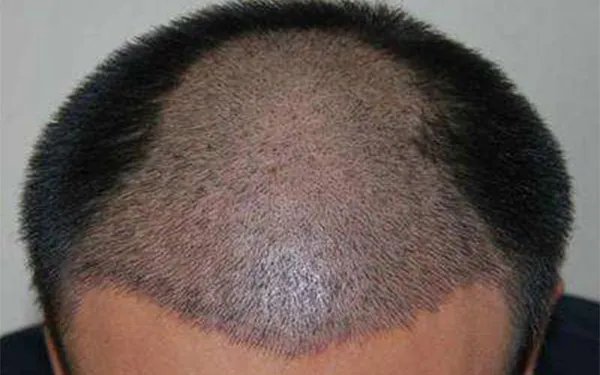 北京微创植发整形医院哪里好_知名微创植发美容整形医院有哪些【附价格】