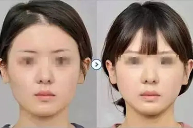 瘦脸针一支10天效果图